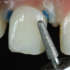 Preparación del diente 
