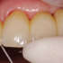 Removal of excess cement from interdental spaces