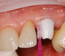 IMPLANT
