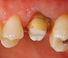 Préparation supra et juxta gingivale