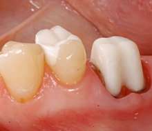 Subgingival