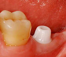 Non-retentive abutment shape