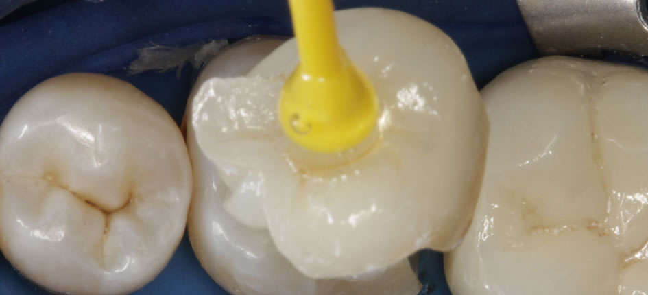 Placement of the restoration using Variolink Esthetic