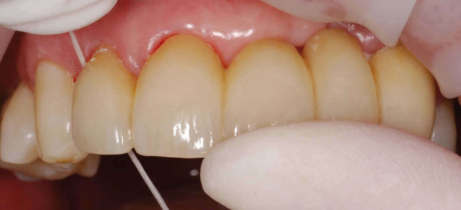 Removal of excess cement from interdental spaces