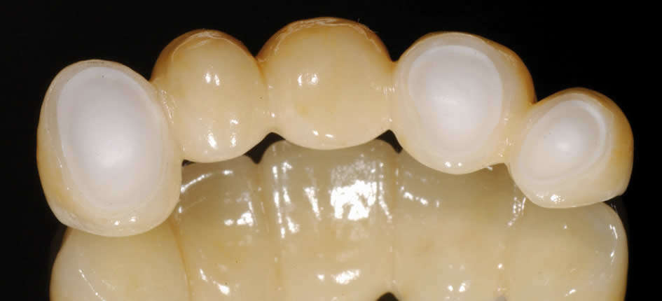 Bridge made of IPS ZirCAD/ZirPress