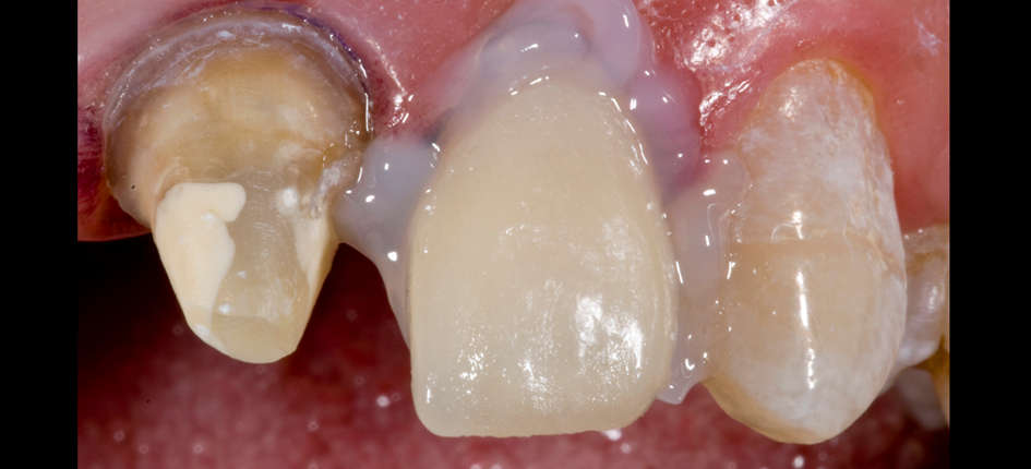 Application du Liquid Strip