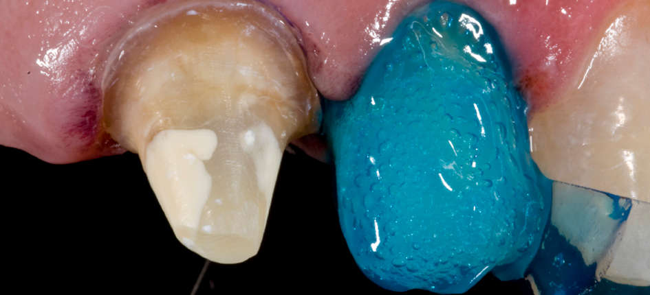 Mordançage à l'acide phosphorique